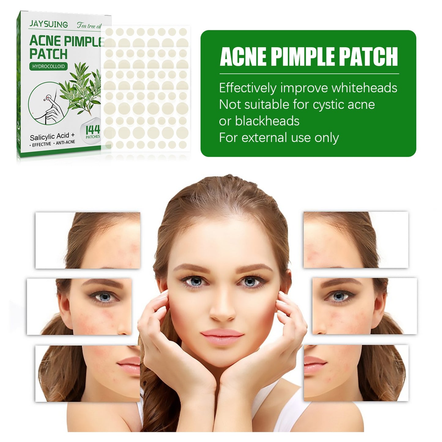 Acne Pimple Patches 144Ct
