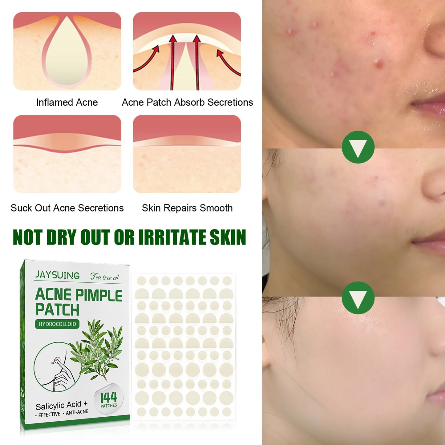 Acne Pimple Patches 144Ct